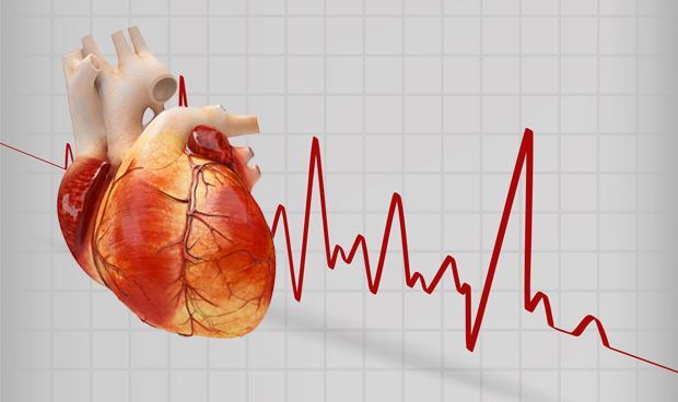 Cardiac Arrhythmias