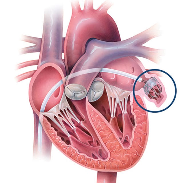 Atrial Fibrillation