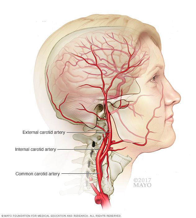 Carotid Artery Disease