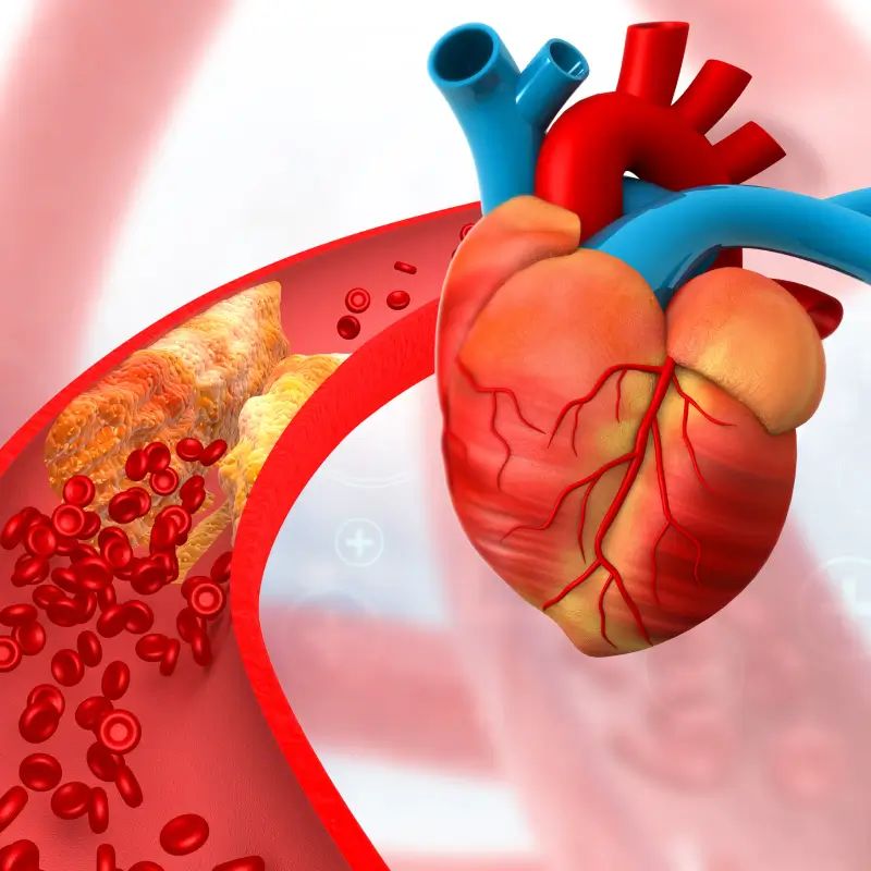 Coronary Artery Disease