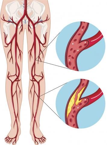 Peripheral Artery Disease